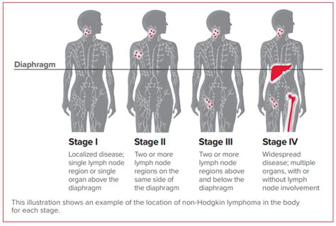 https://www.lls.org/lymphoma/non.